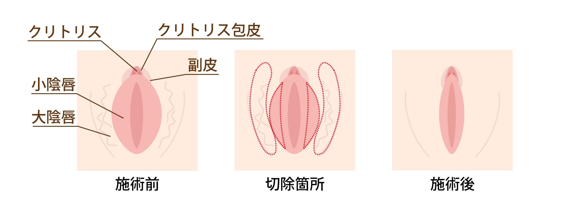 大陰唇と小陰唇を同時に手術できる