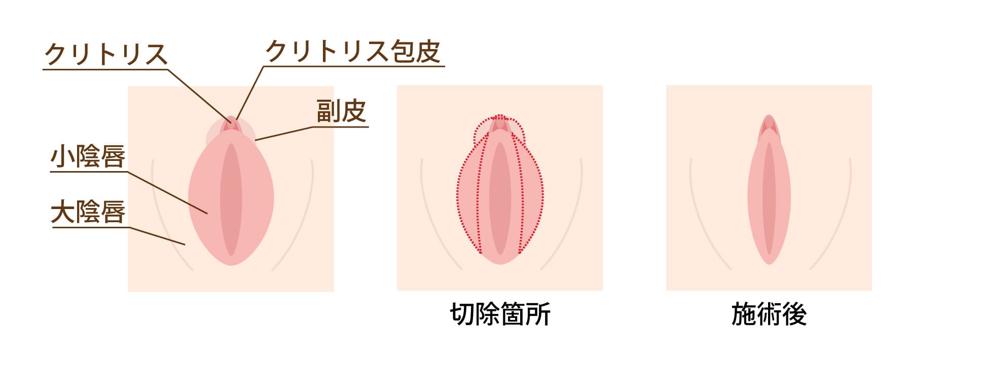 恥垢がたまりやすい