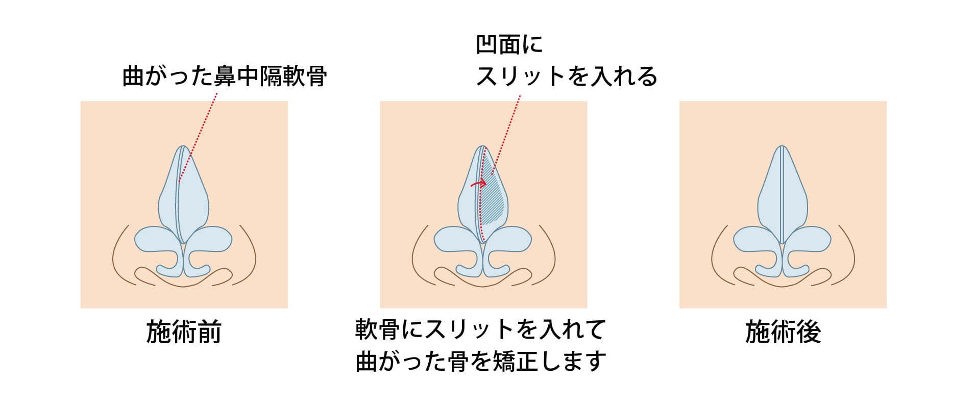 曲がった鼻筋を真っ直ぐにする