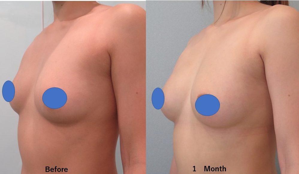 デコルテ部分をしっかり豊胸。1か月後の経過