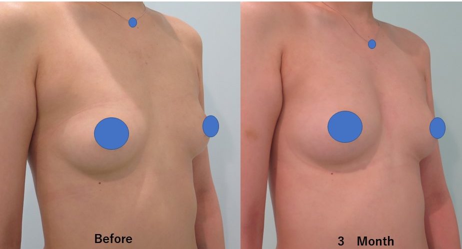 ばれない豊胸３か月目の経過