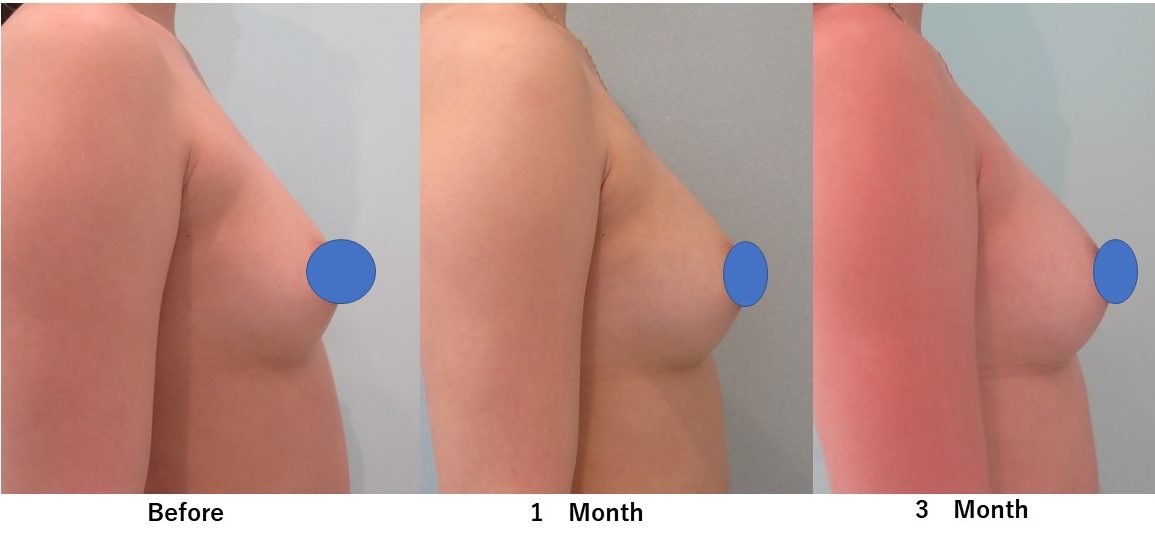 ばれない豊胸後の大きさの変化