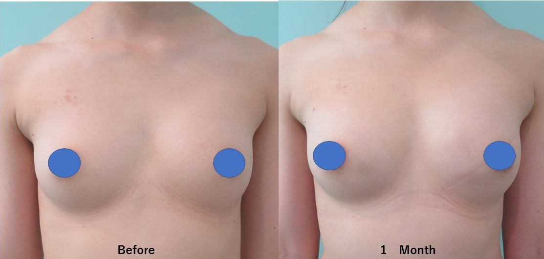 ばれない豊胸1か月後の経過