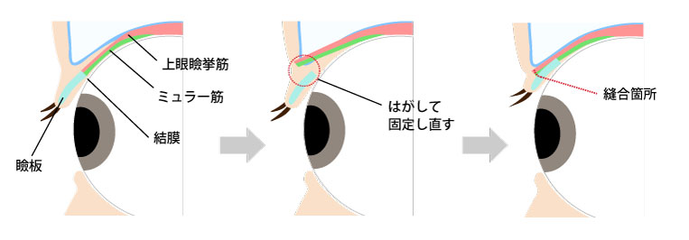 挙筋短縮