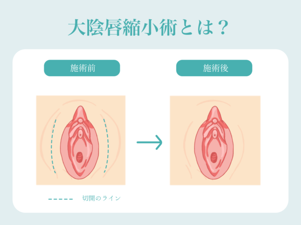 大陰唇縮小術とは？