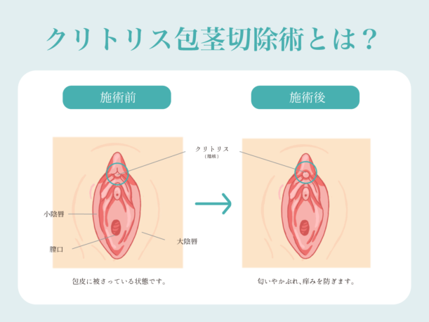 クリトリス包茎切除術とは？