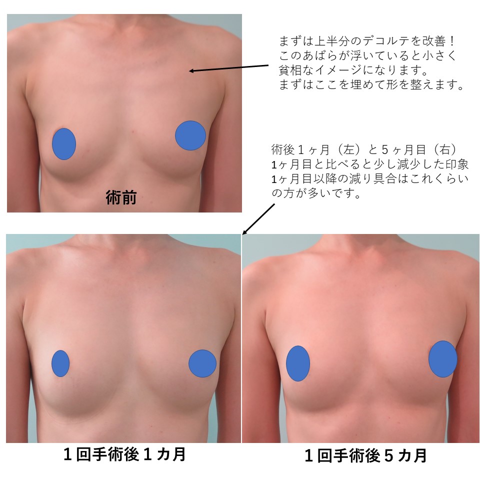 3回ばれない豊胸をした方の経過①