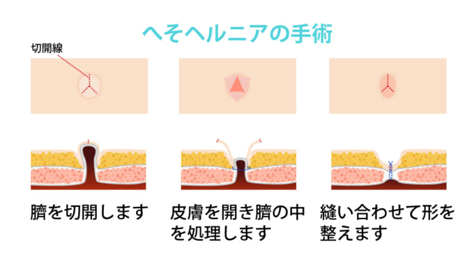 へそヘルニアの手術