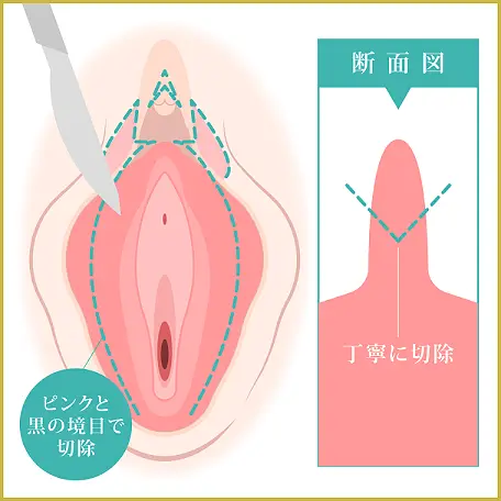 小陰唇の余分な部分を丁寧に切除