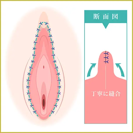 小陰唇に傷跡が残らないように縫合