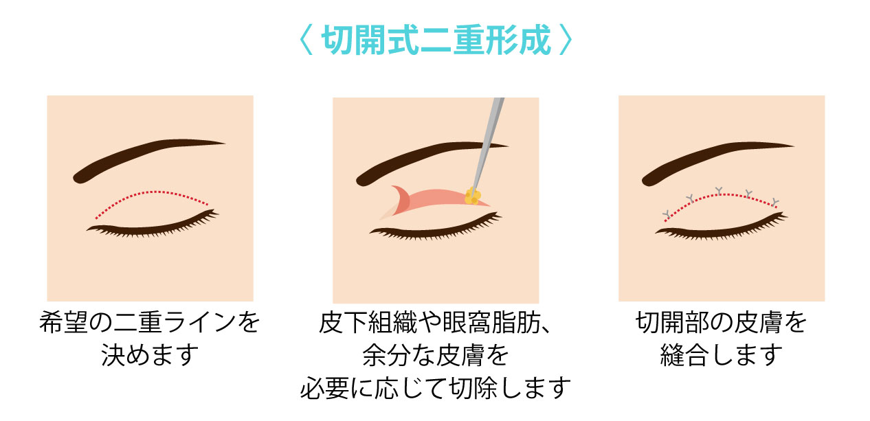 切開式二重形成