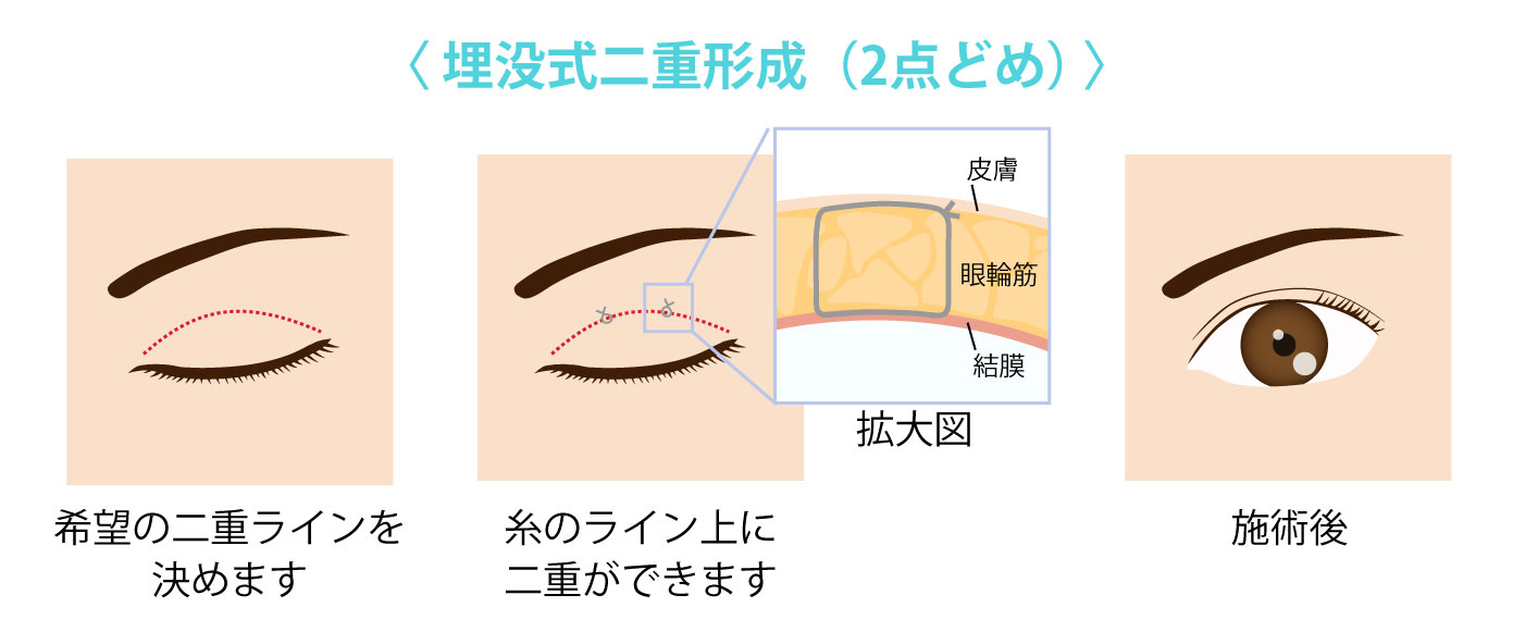 埋没式二重形成（２点どめ）