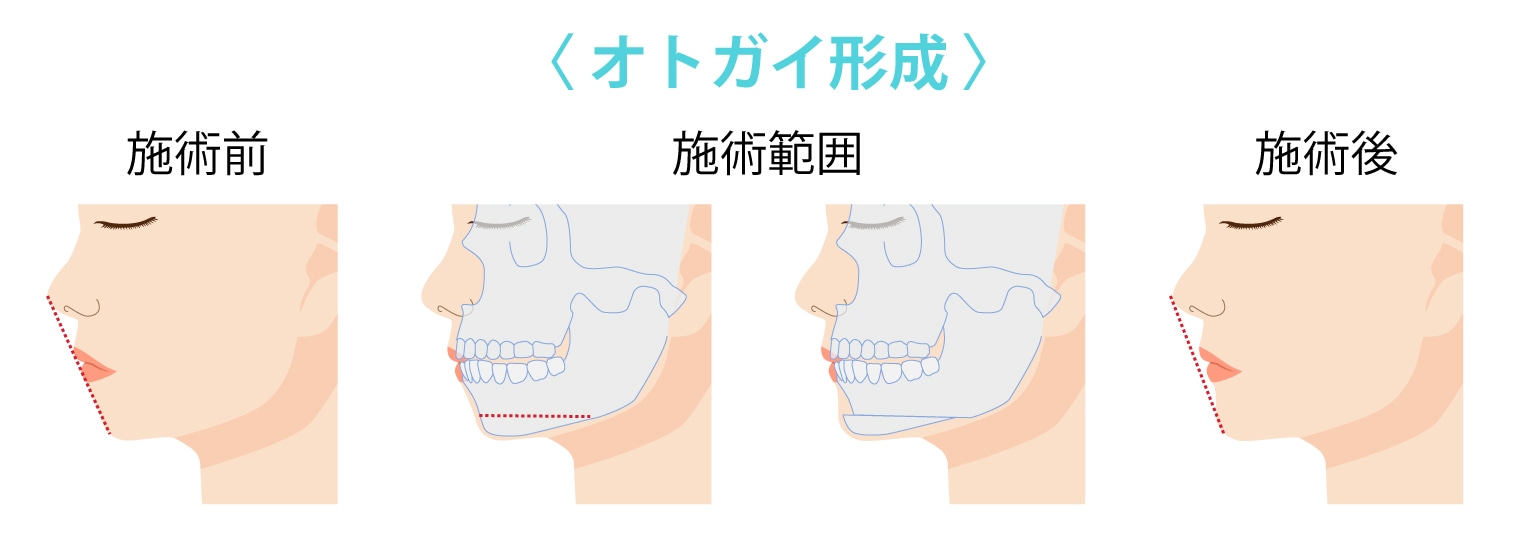 オトガイ形成