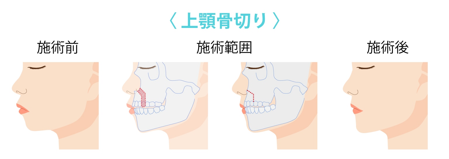 上顎骨切り