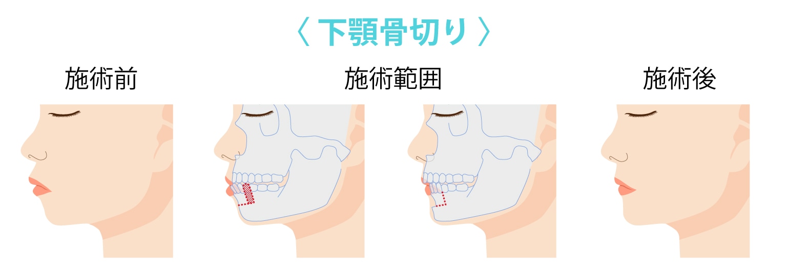 下顎骨切り