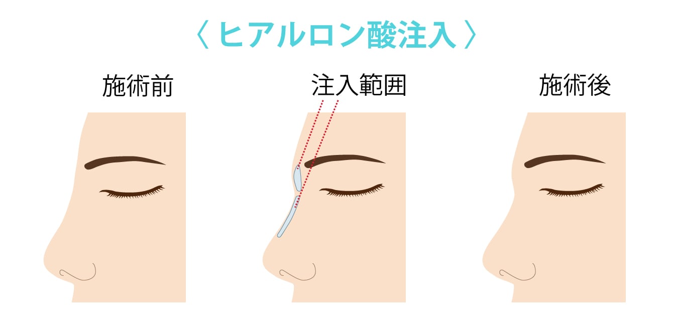 ヒアルロン酸注入_鼻