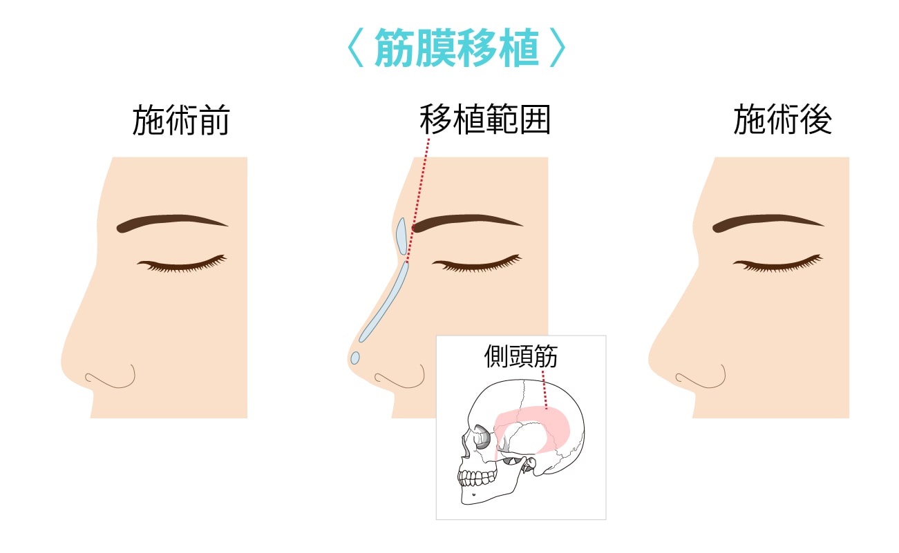 筋膜移植_鼻