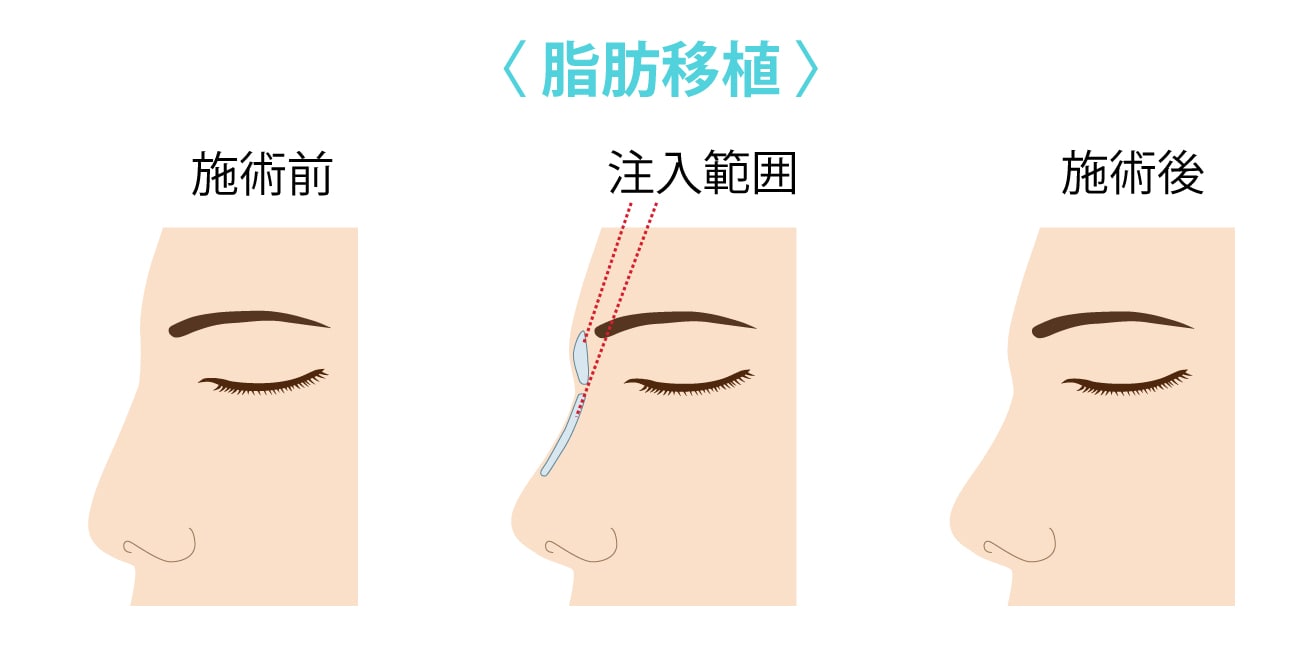 脂肪移植_鼻