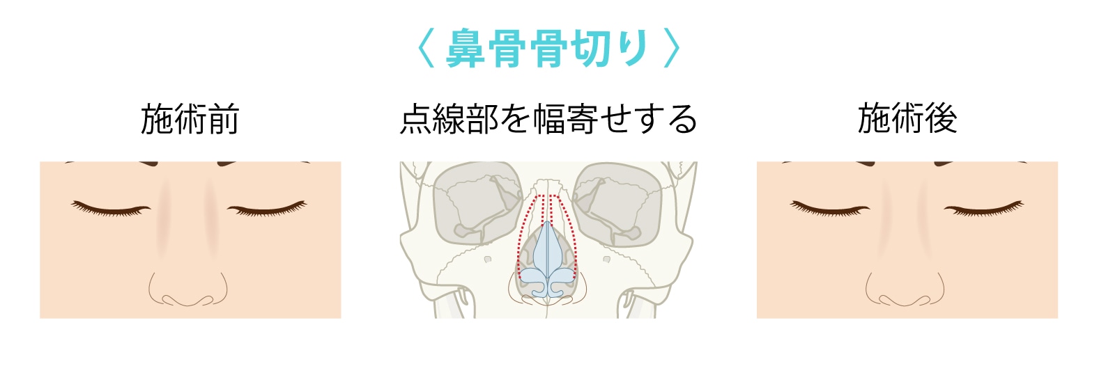 鼻骨_骨切り