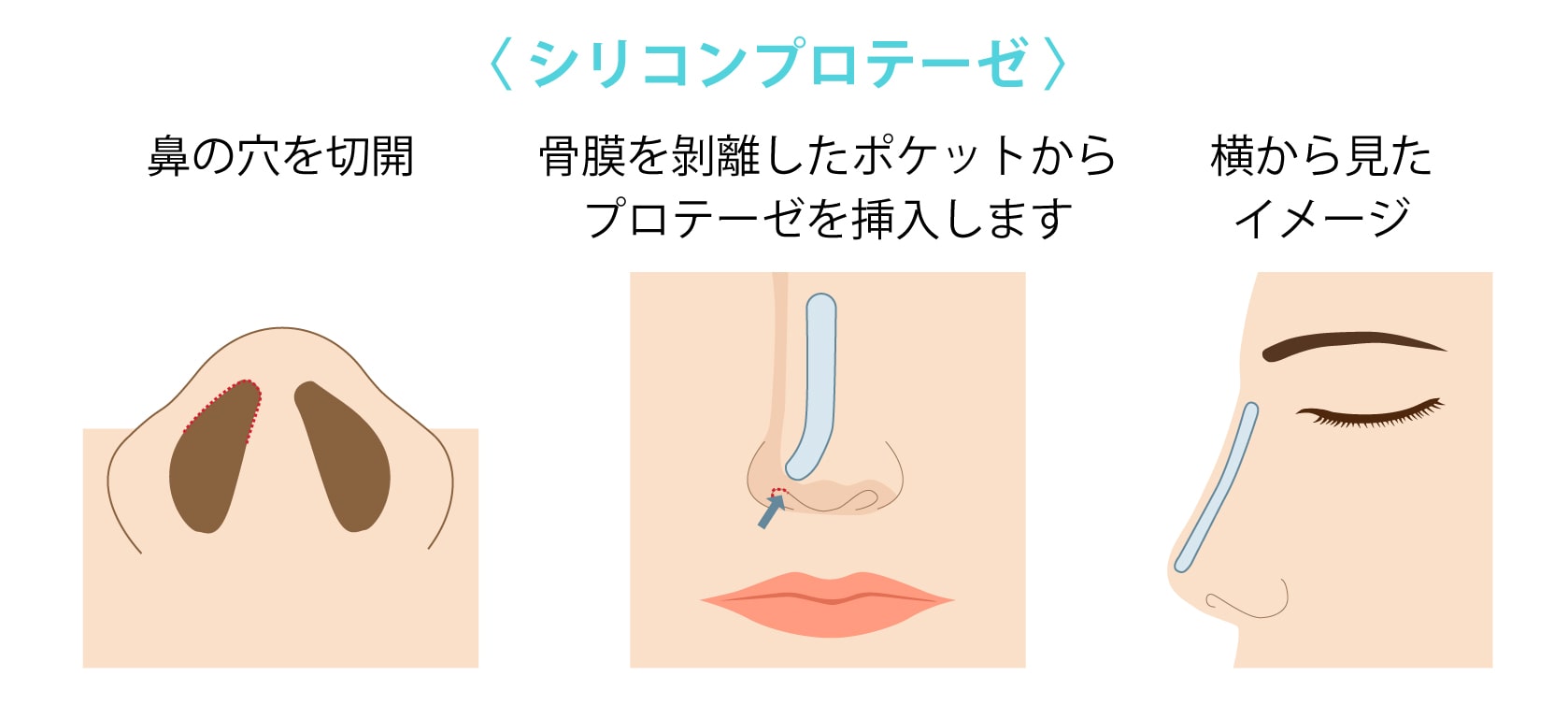 シリコンプロテーゼによる鼻筋形成