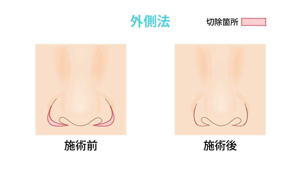 小鼻縮小_外側法