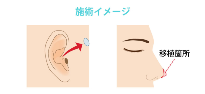 耳介軟骨移植_施術イメージ