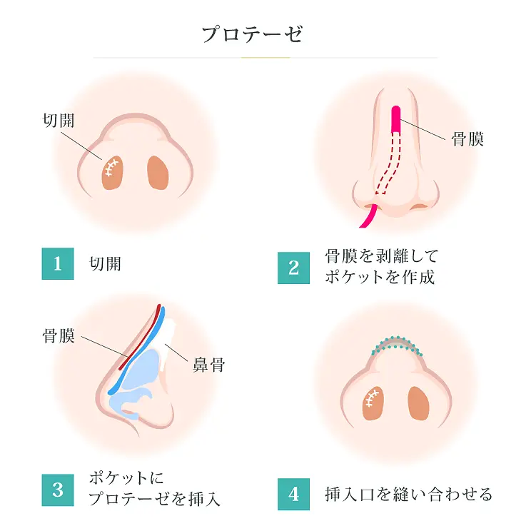 プロテーゼ(鼻筋)