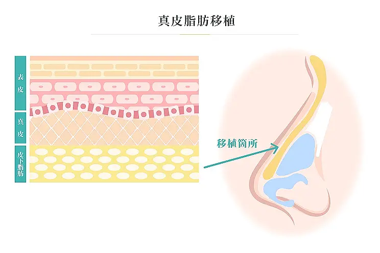 真皮脂肪移植