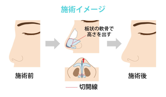 鼻中隔延長_施術イメージ