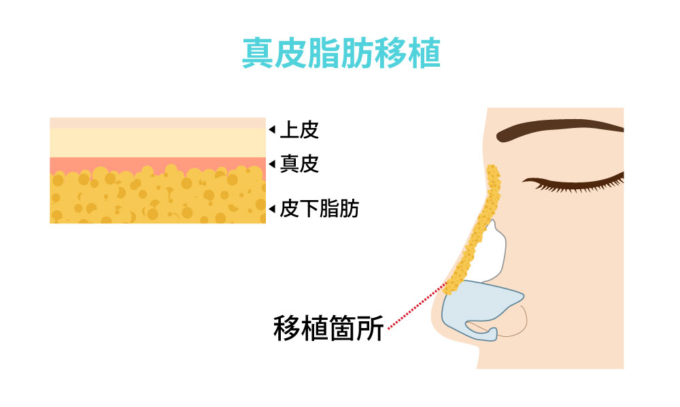 真皮脂肪移植_施術イメージ