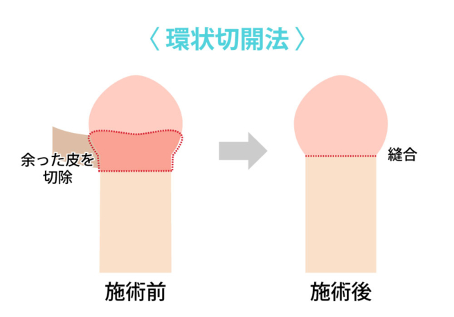 環状切開法