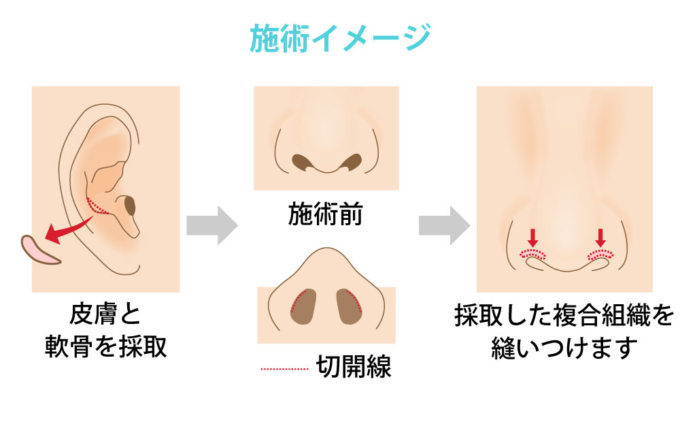 鼻孔縁下降_施術イメージ