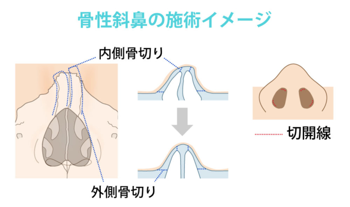 斜鼻形成_骨性斜鼻