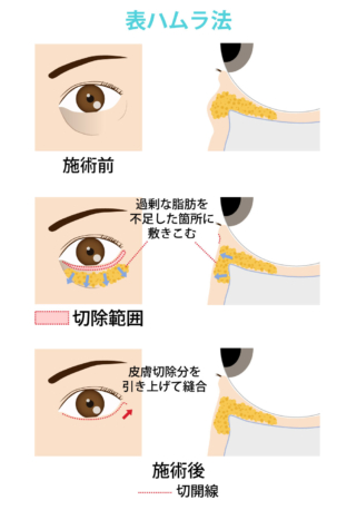 まぶたの若返り_表ハムラ法