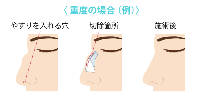 ハンプ削り（重度）