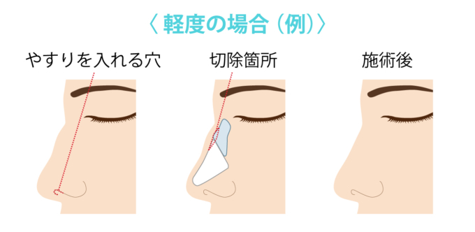 ハンプ削り（軽度）