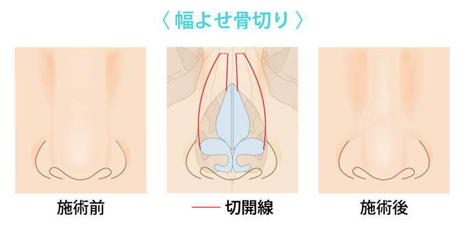 幅寄せ骨切り