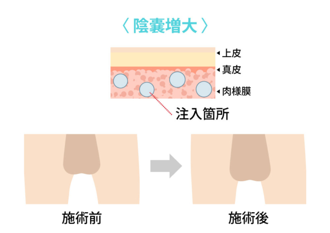 陰嚢増大