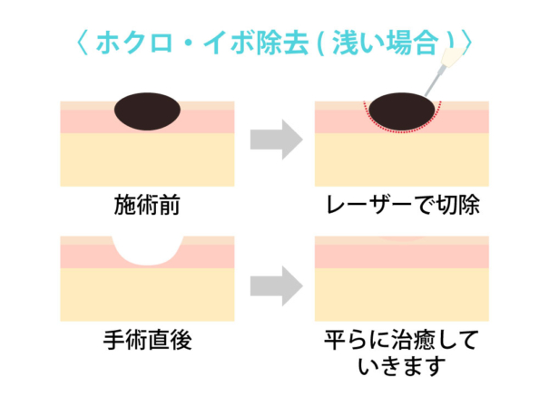 ホクロイボ除去_浅い場合