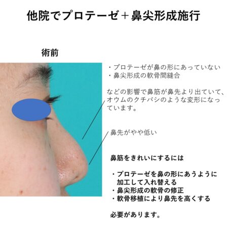 他院修正　鼻筋を整える