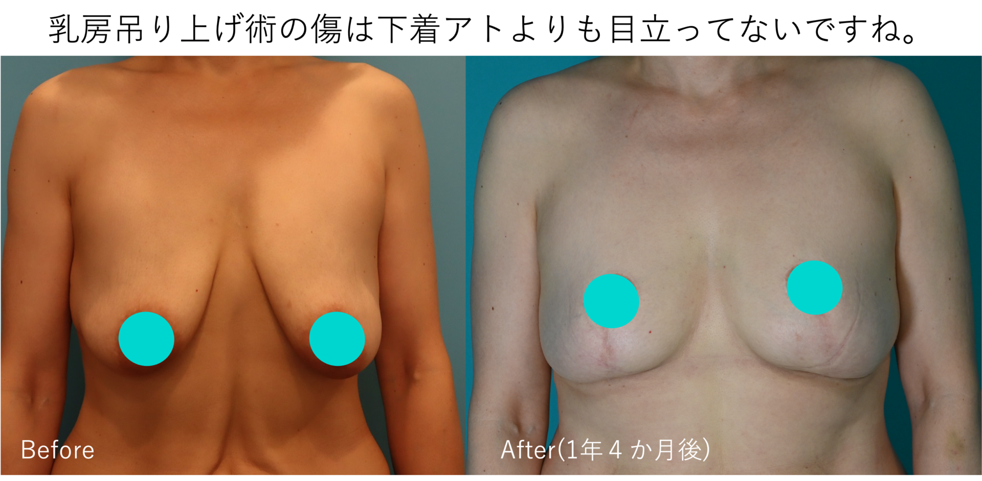 乳房吊り上げの切開した傷の様子がわかる写真施術前後イメージ