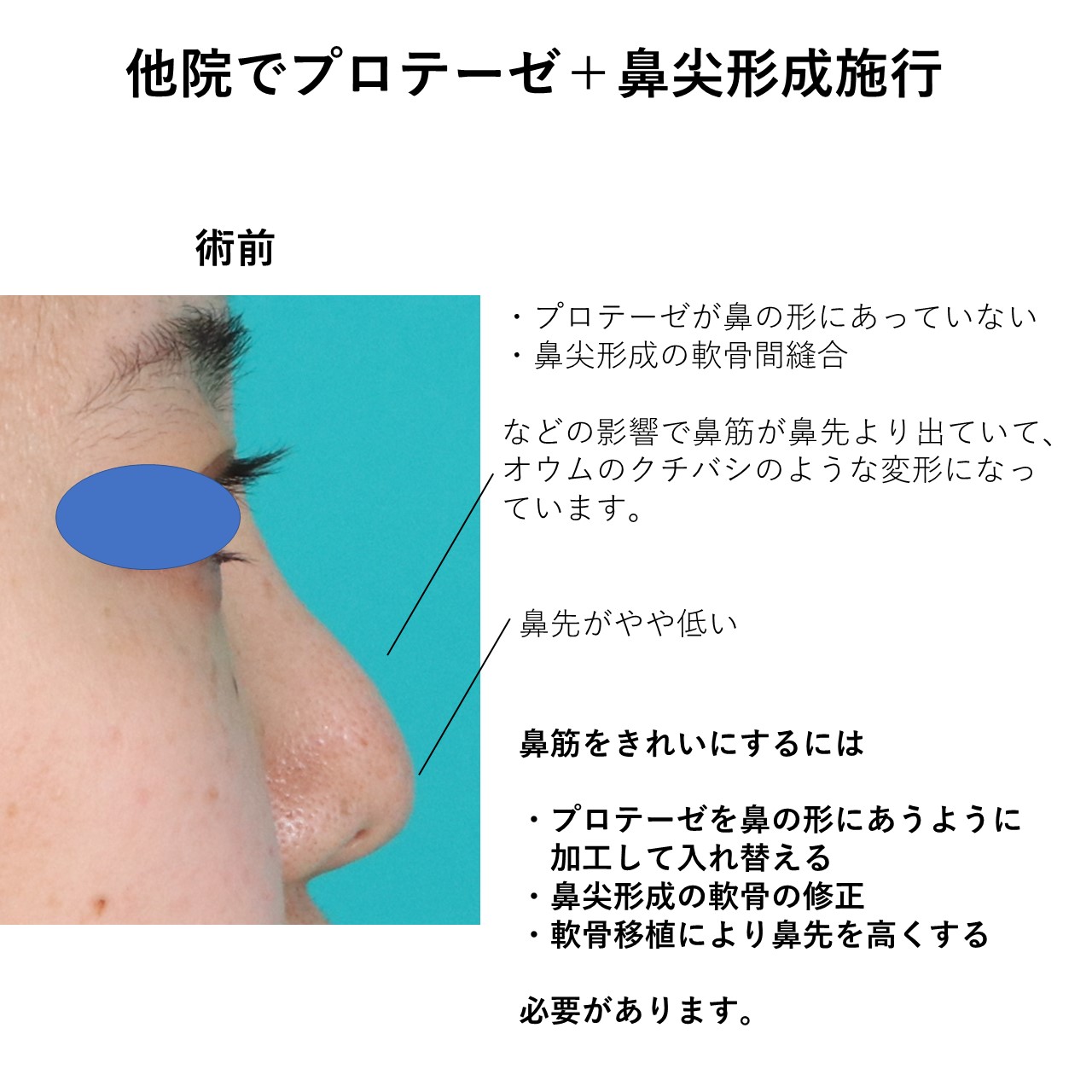 プロテ入れ替え鼻尖形成修正軟骨移植施術前後イメージ