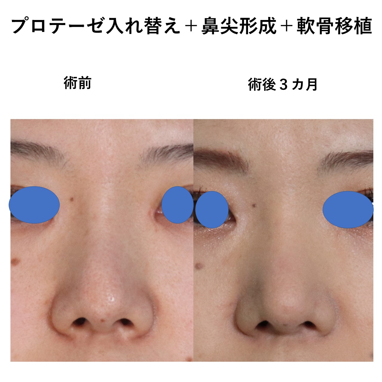 プロテ入れ替え鼻尖形成修正軟骨移植施術前後イメージ