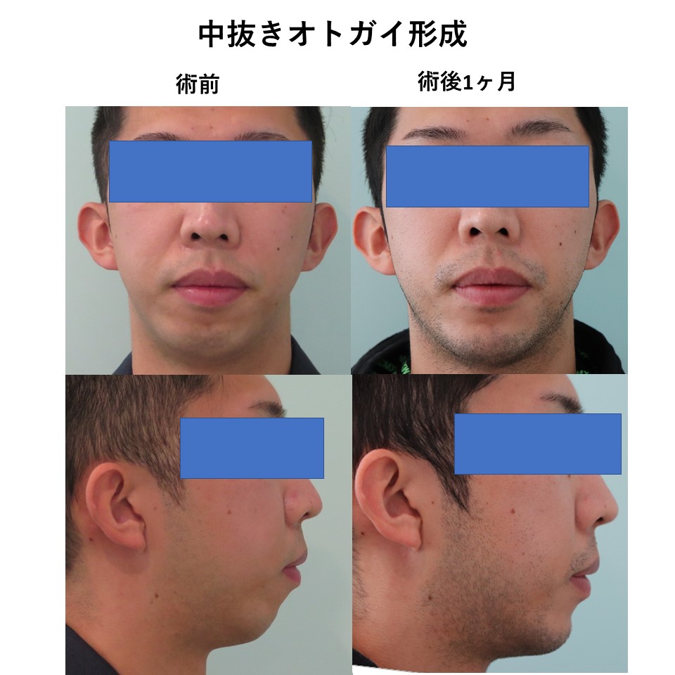 口ゴボの改善、中抜きとオトガイ形成施術前後イメージ