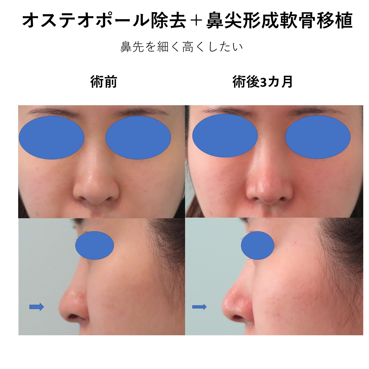 オステオポール抜去し鼻尖形成軟骨移植で再建施術前後イメージ