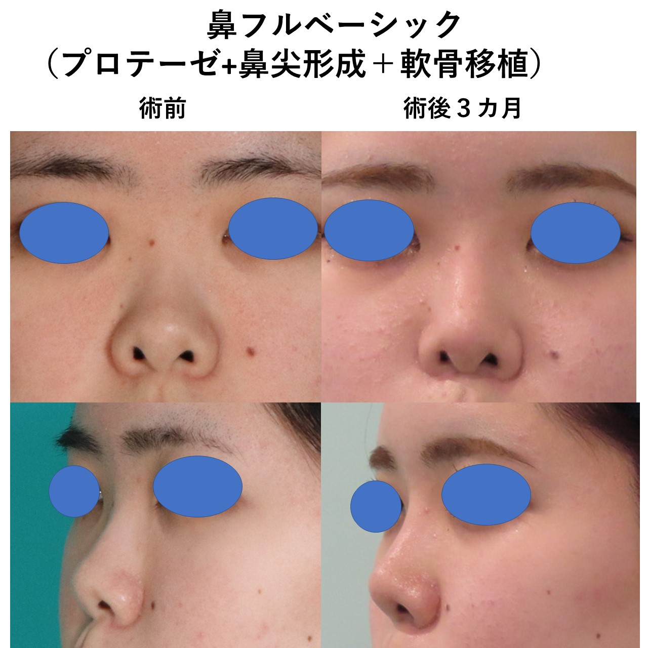 鼻フルベーシックプロテ鼻尖軟骨移植施術前後イメージ