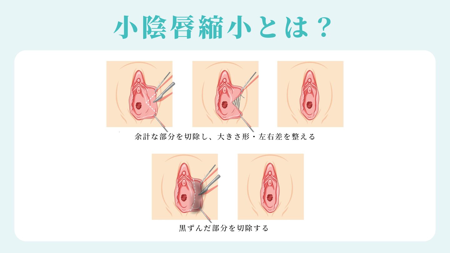 小陰唇縮小とは？