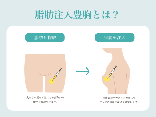 脂肪注入豊胸とは？