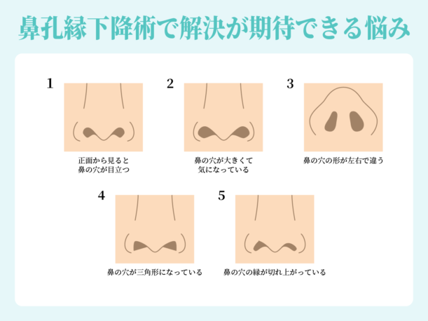 鼻孔縁下降術で解決が期待できる悩み