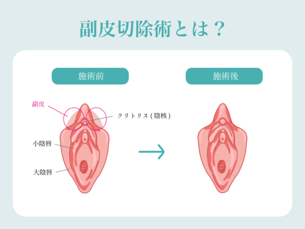 副皮切除術とは？